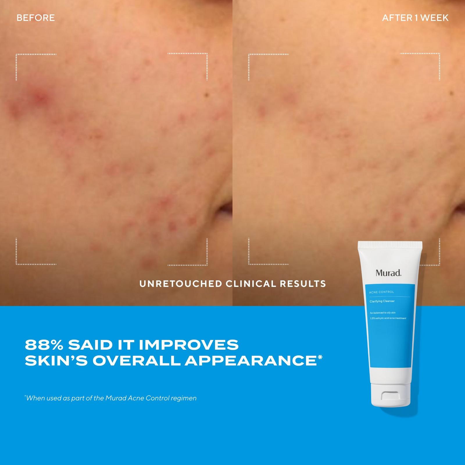 Acne Control Clarifying Cleanser with Salicylic Acid