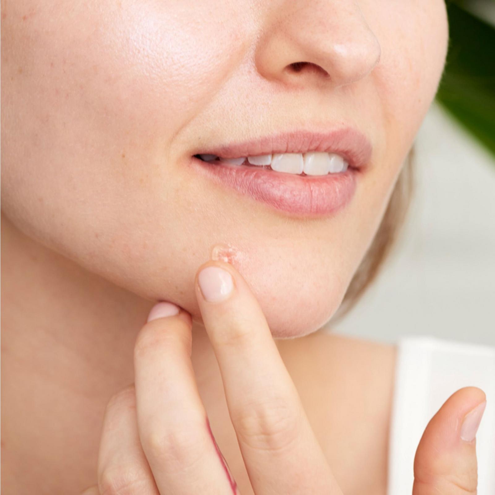 Super Spot Remover Acne Treatment Gel with Salicylic Acid