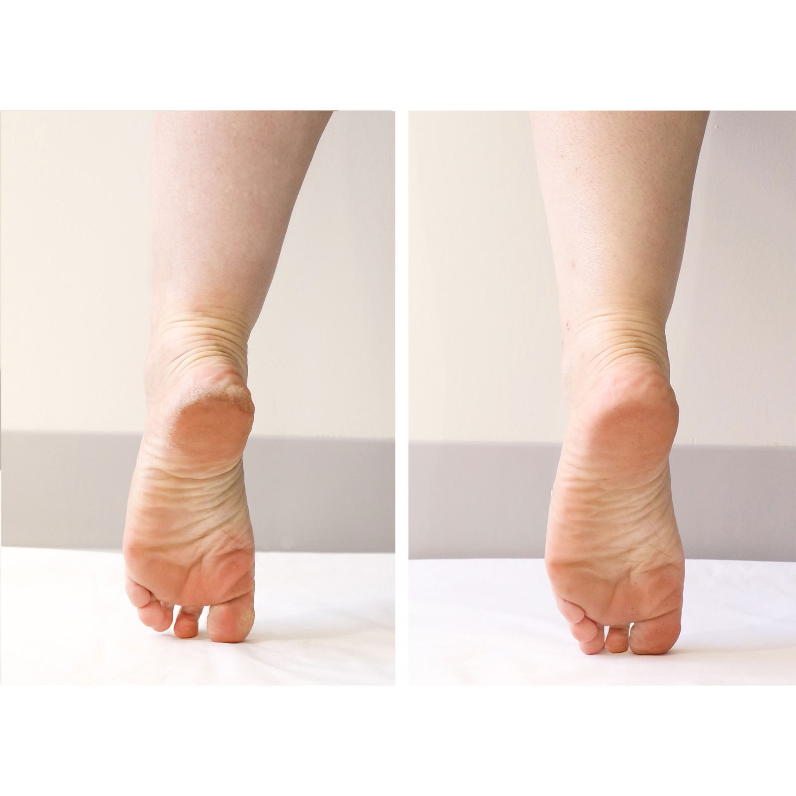 PoshPeel Pedi Cure Intensive Foot Peel Treatment