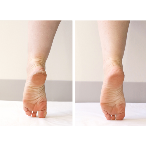 Patchology PoshPeel Pedi Cure Intensive Foot Peel Treatment 4