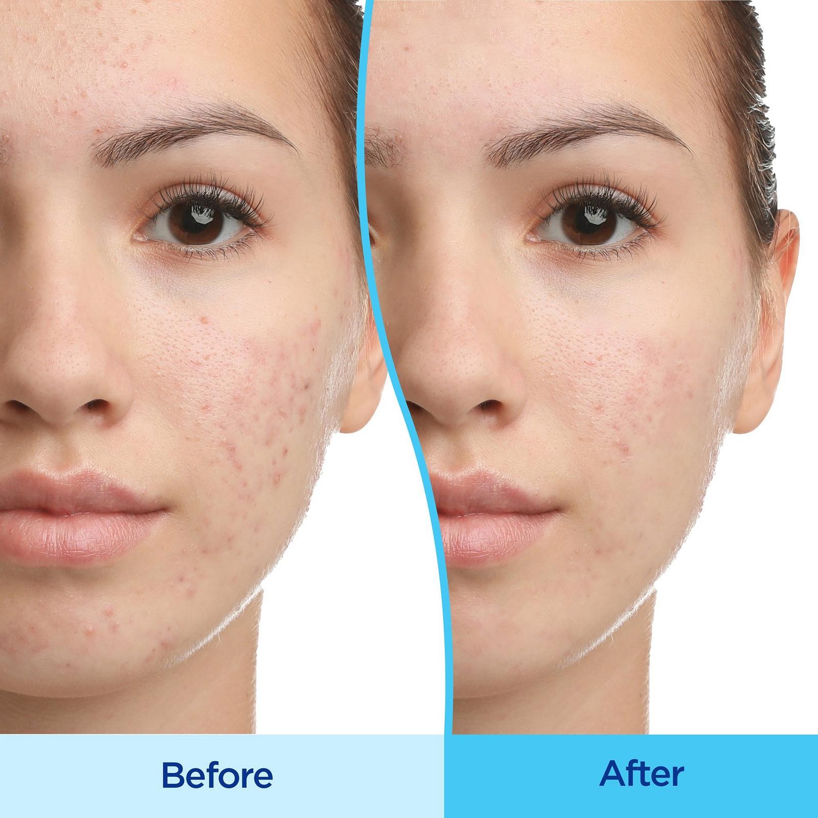 Adapalene 0.1% Acne Treatment Gel