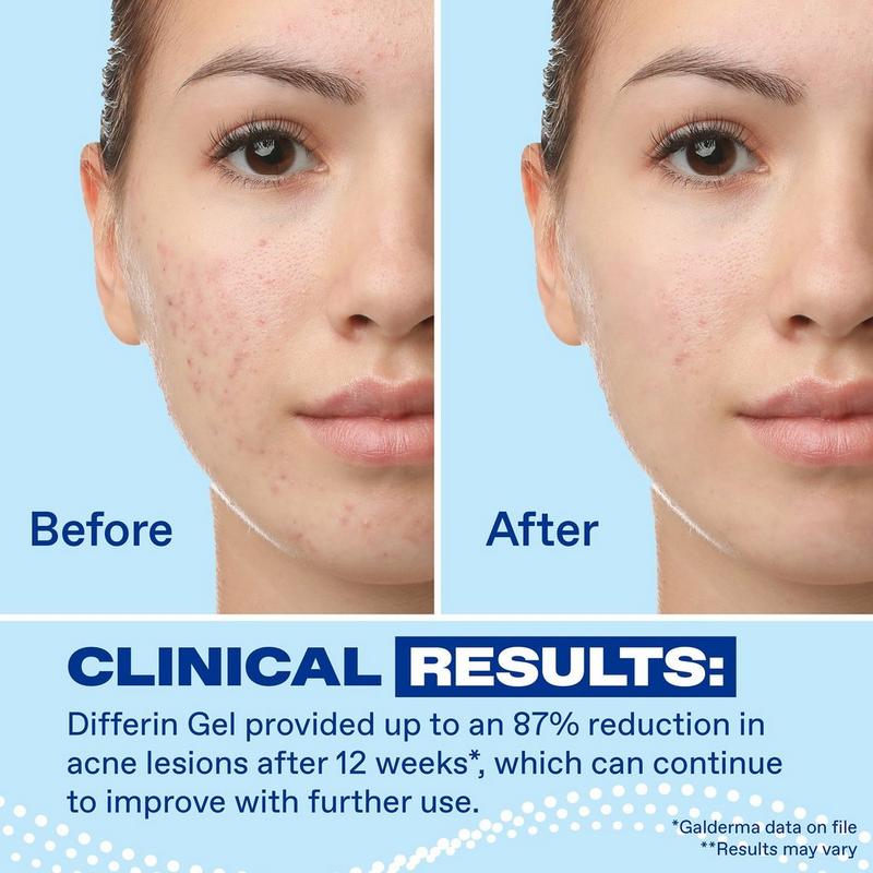 Differin - 1.6 oz Adapalene 0.1% Acne Treatment Gel