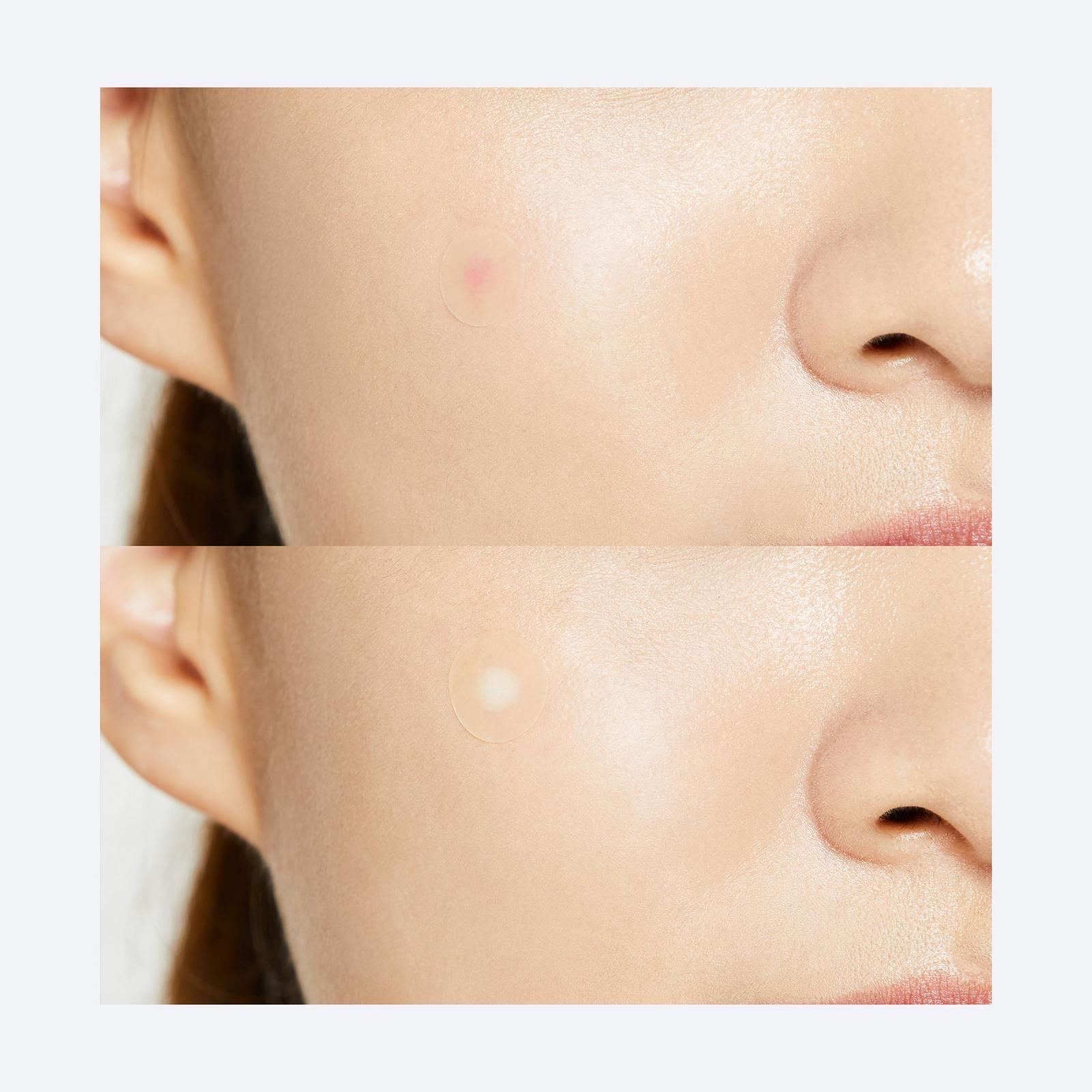 Acne Pimple Master Patch - Original Care