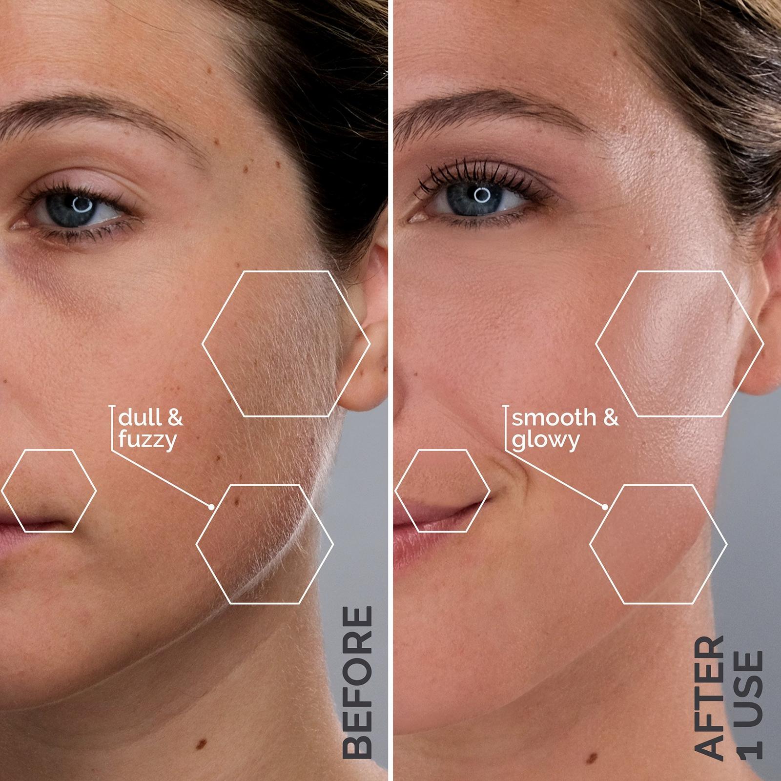 Sonicsmooth Sonic Dermaplaning Exfoliation & Peach Fuzz Removal System
