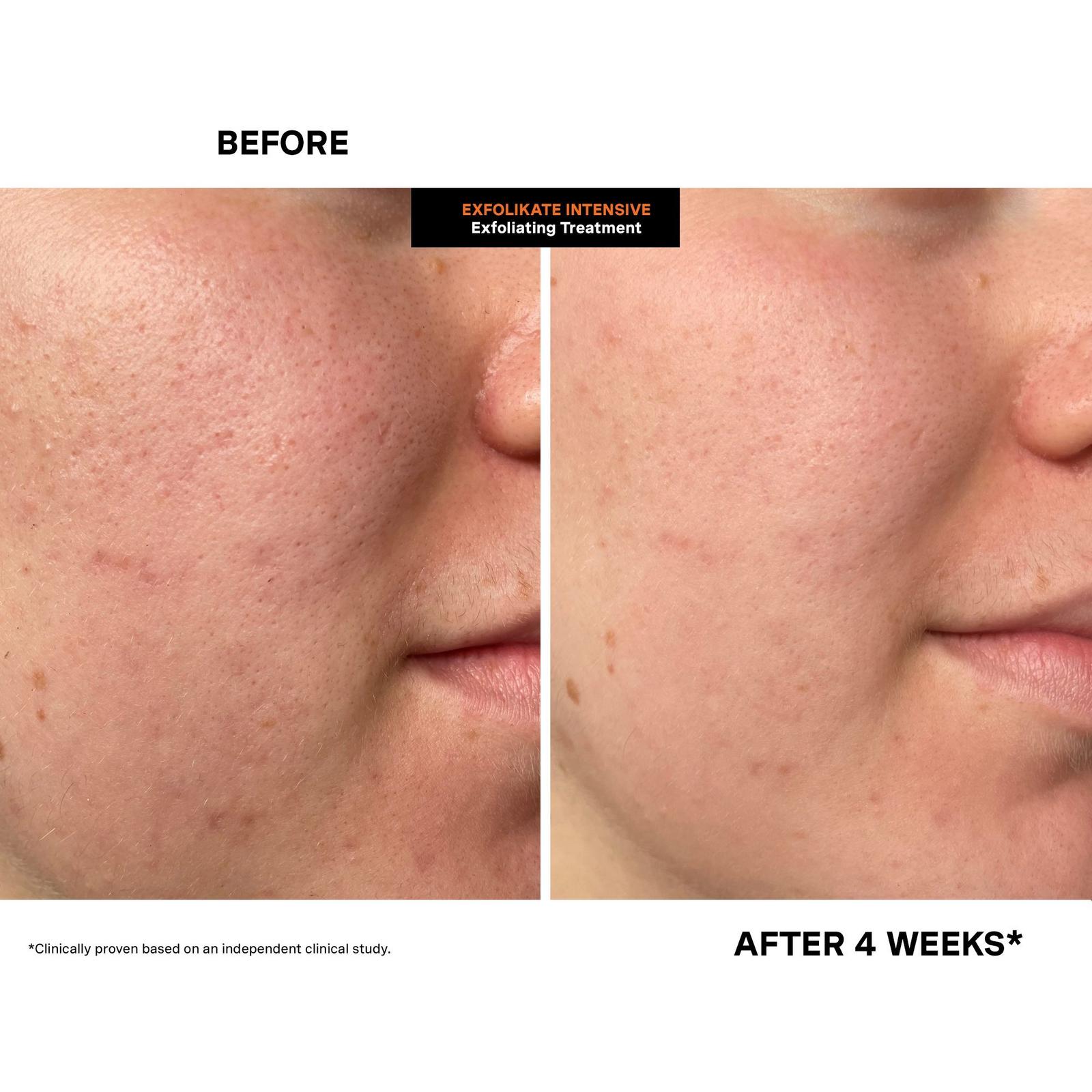 Travel Size ExfoliKate Intensive Exfoliating Treatment