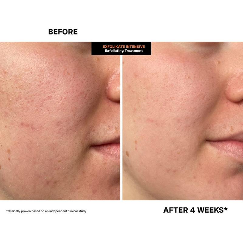 Kate Somerville ExfoliKate Intensive Exfoliating Treatment #4