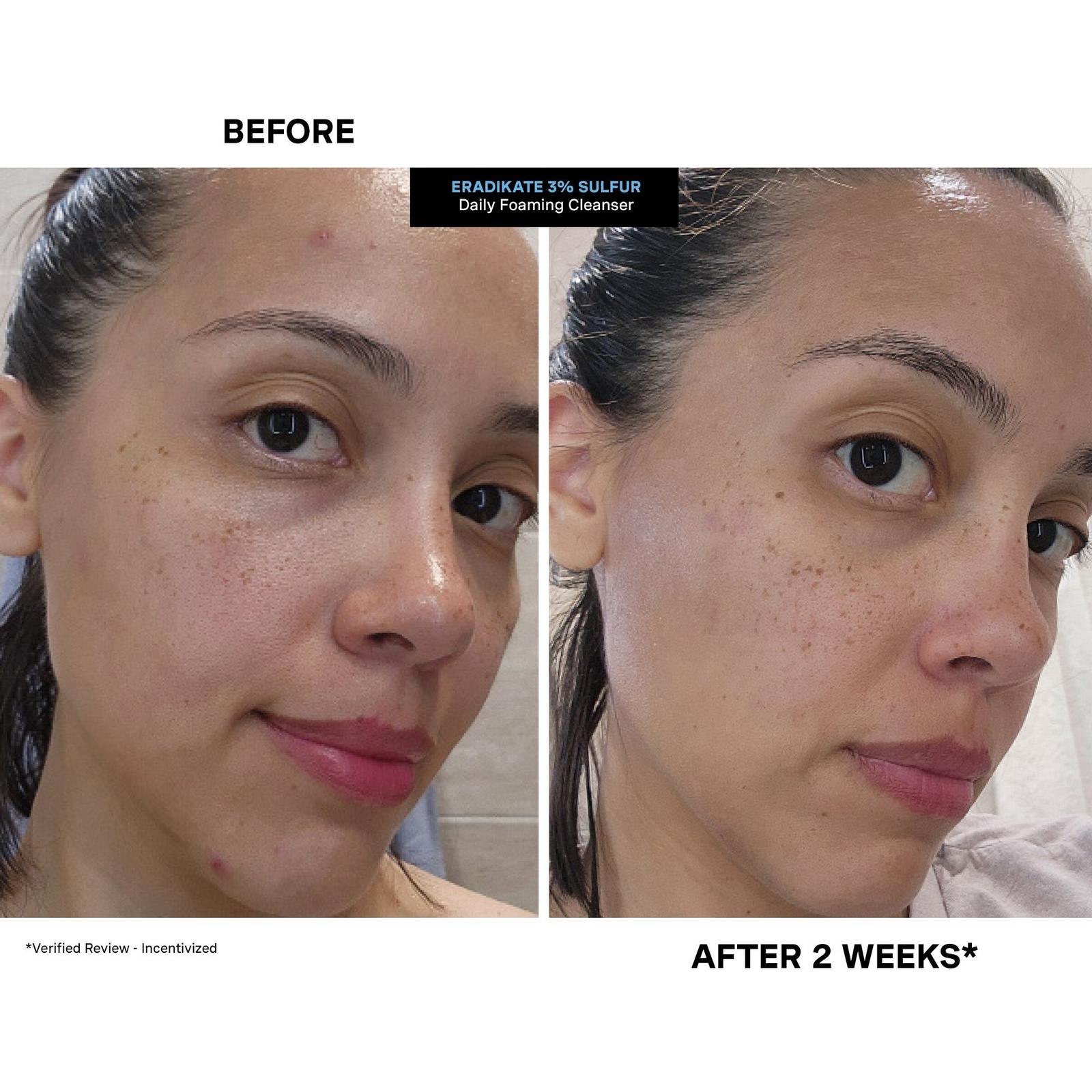 EradiKate 3% Sulfur Daily Foaming Cleanser + Acne Treatment