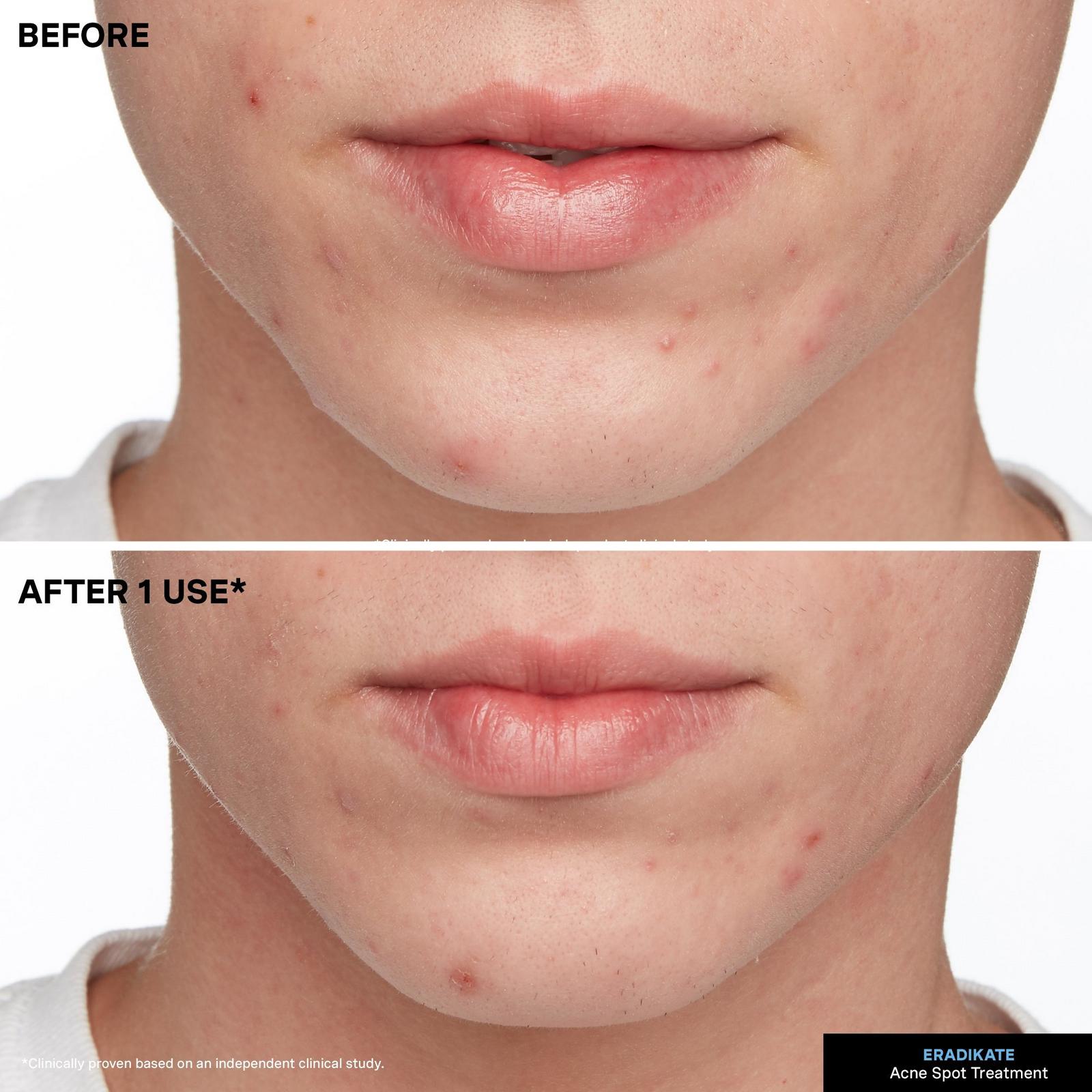 EradiKate Acne Spot Treatment with 10% Sulfur