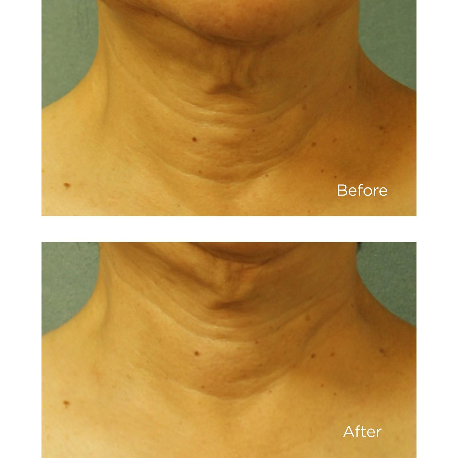 Cold Plasma Plus+ Neck & Chest Broad Spectrum SPF 25