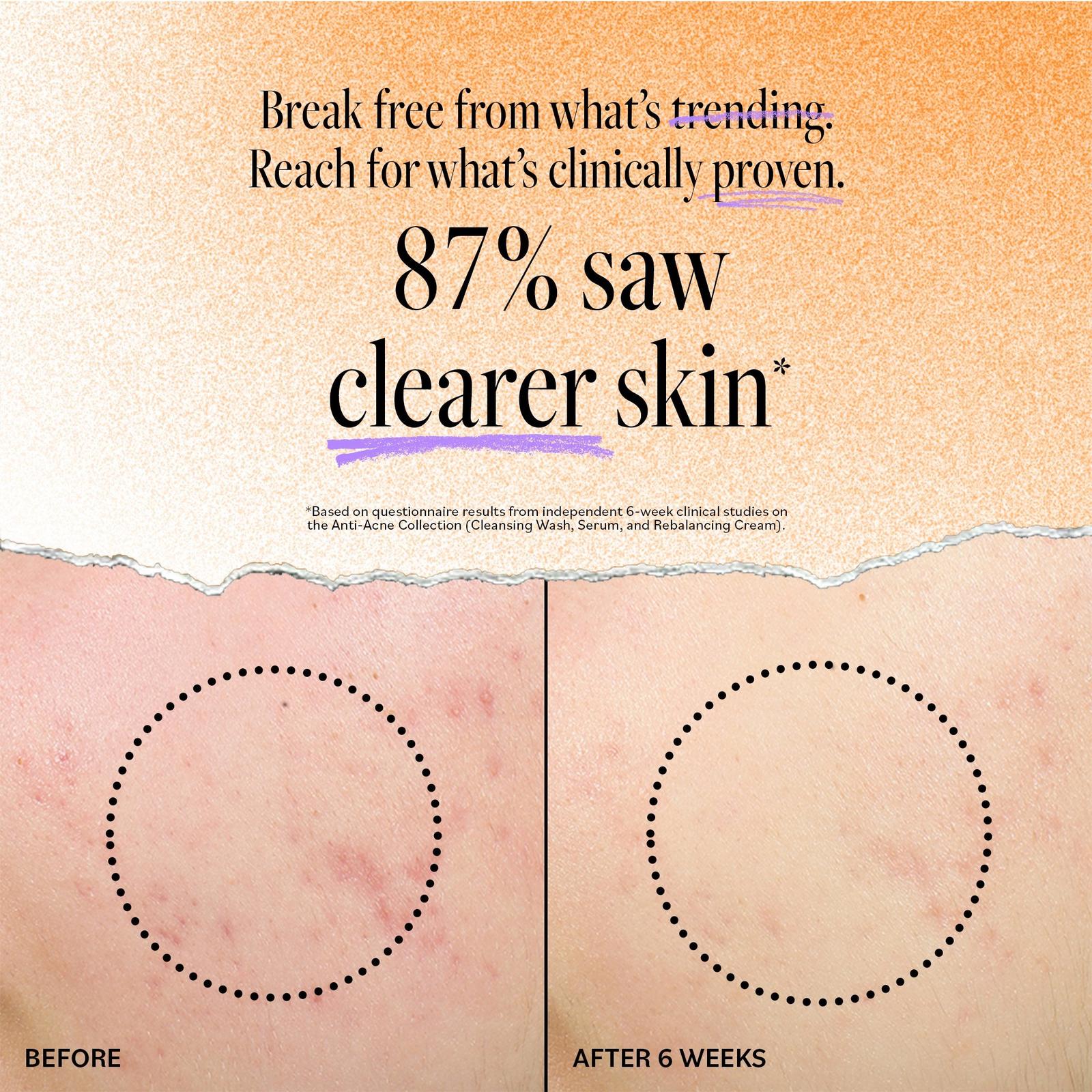 DERMA E - Acne Blemish Control Treatment Serum | Ulta Beauty