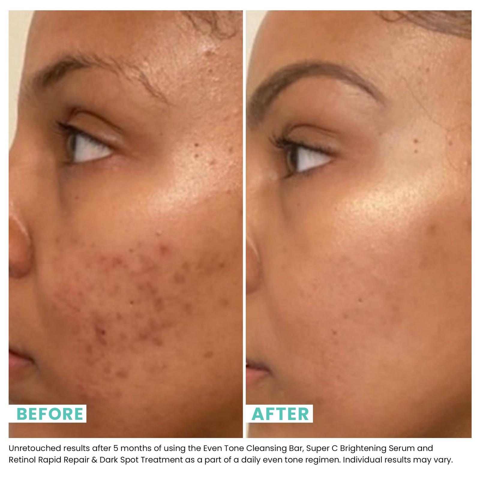 Even Tone Cleansing Bar 3-in-1 Treatment