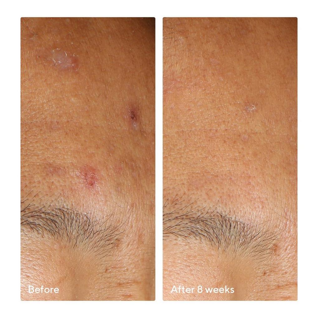 Murad invisiscar deals resurfacing treatment