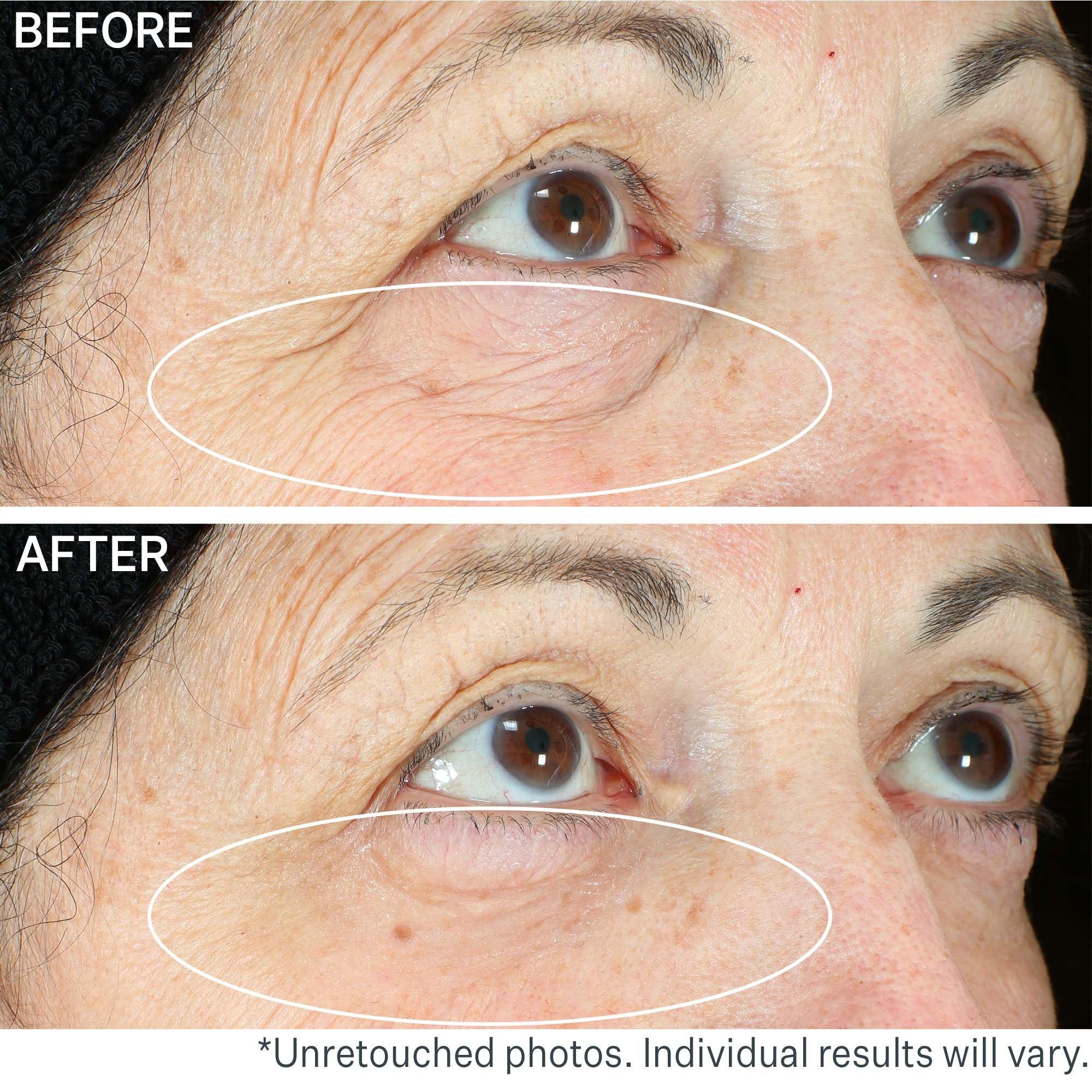 Сумки StriVectin Hyperlift Eye Instant Eye Fix For, Lines & Crepiness — фото 9