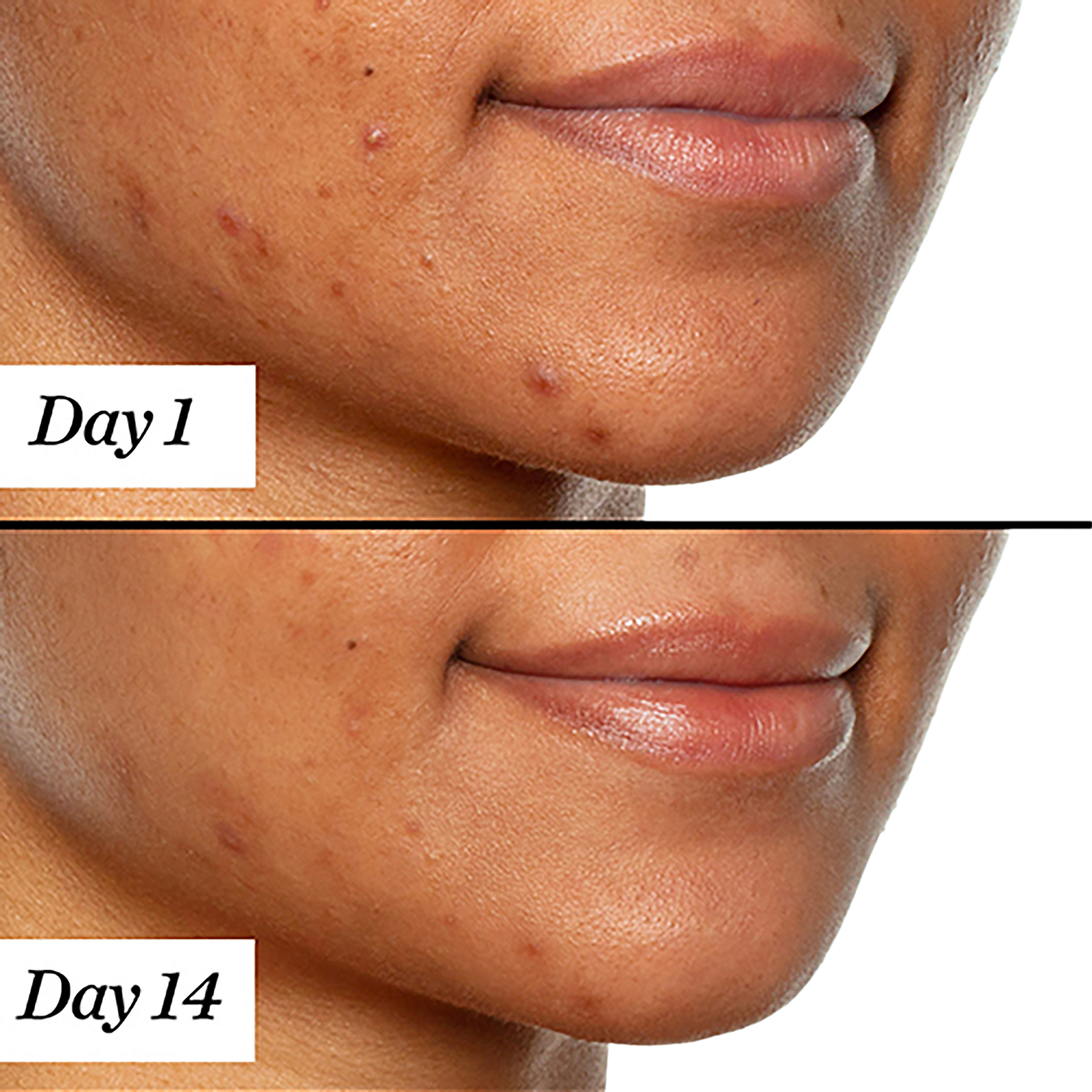 U.F.O. Ultra-Clarifying Acne Treatment Face Oil