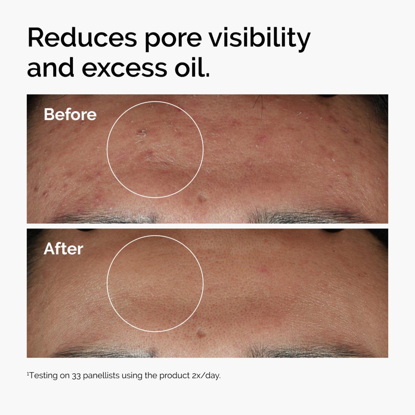 Niacinamide 10% + Zinc 1% Oil Control Serum