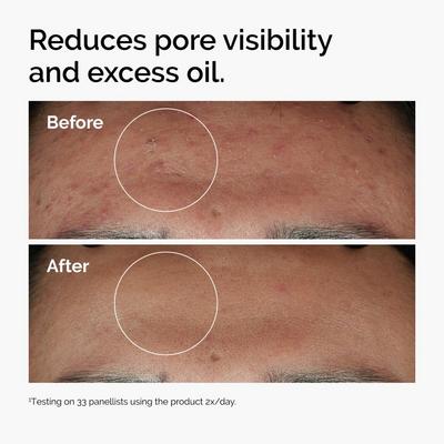 Niacinamide 10% + Zinc 1% Serum for Oily Skin