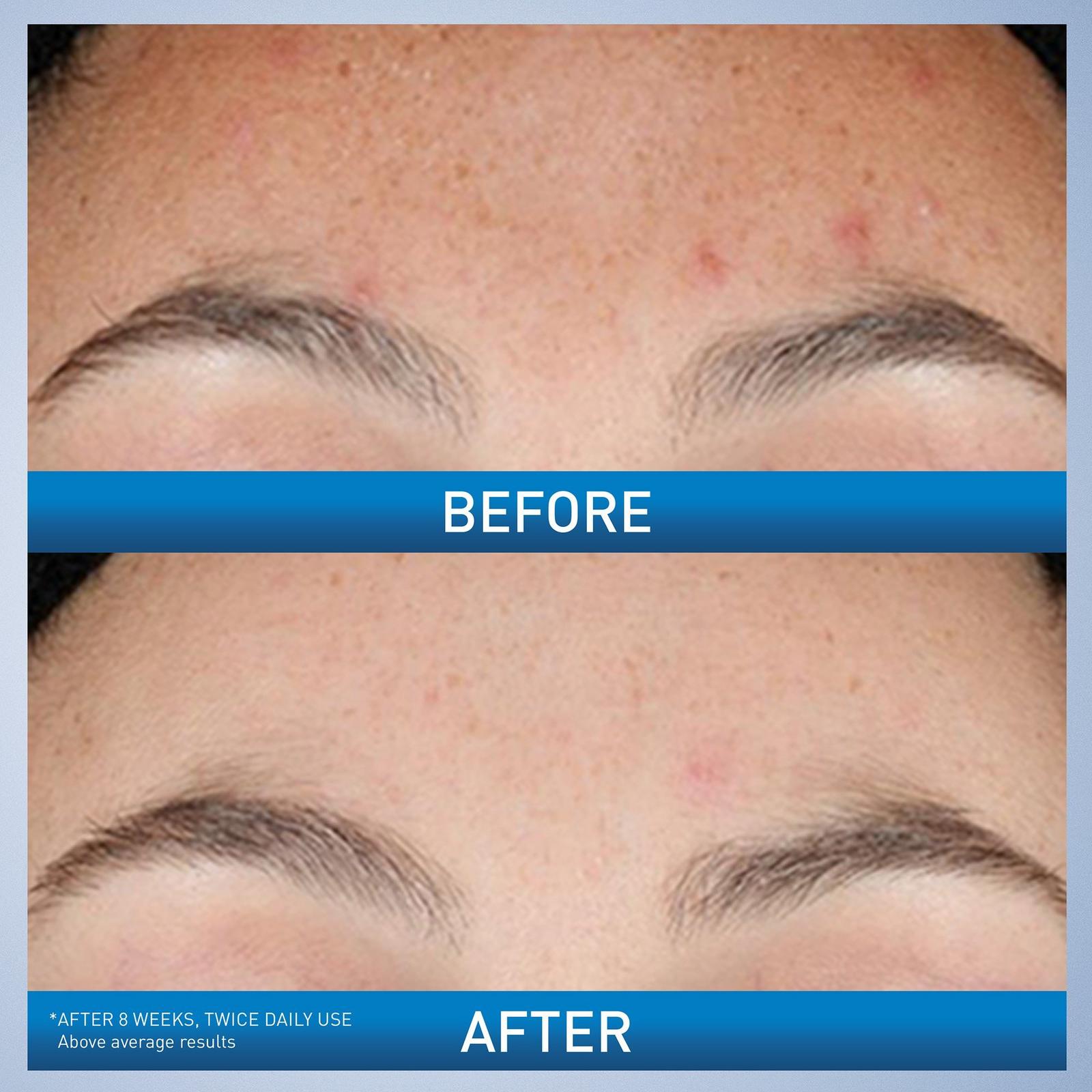 Resurfacing Retinol Facial Serum for Acne Prone Skin