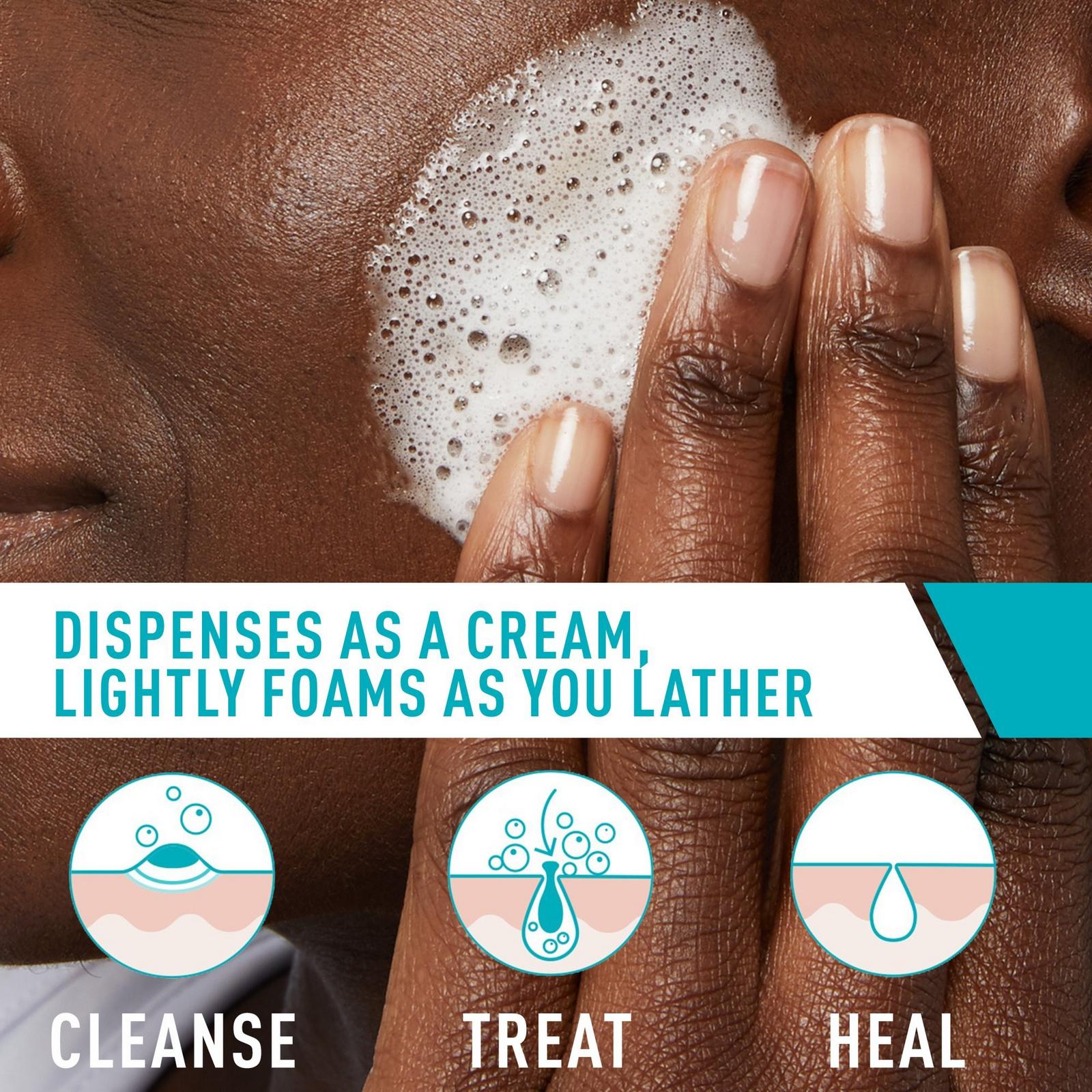 Acne Foaming Cream Cleanser BPO 4% for Acne Prone Skin