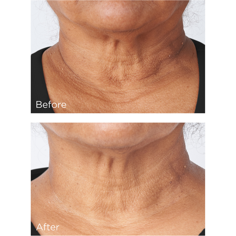 Perricone MD Cold Plasma Plus+ Sub-D/Neck #4
