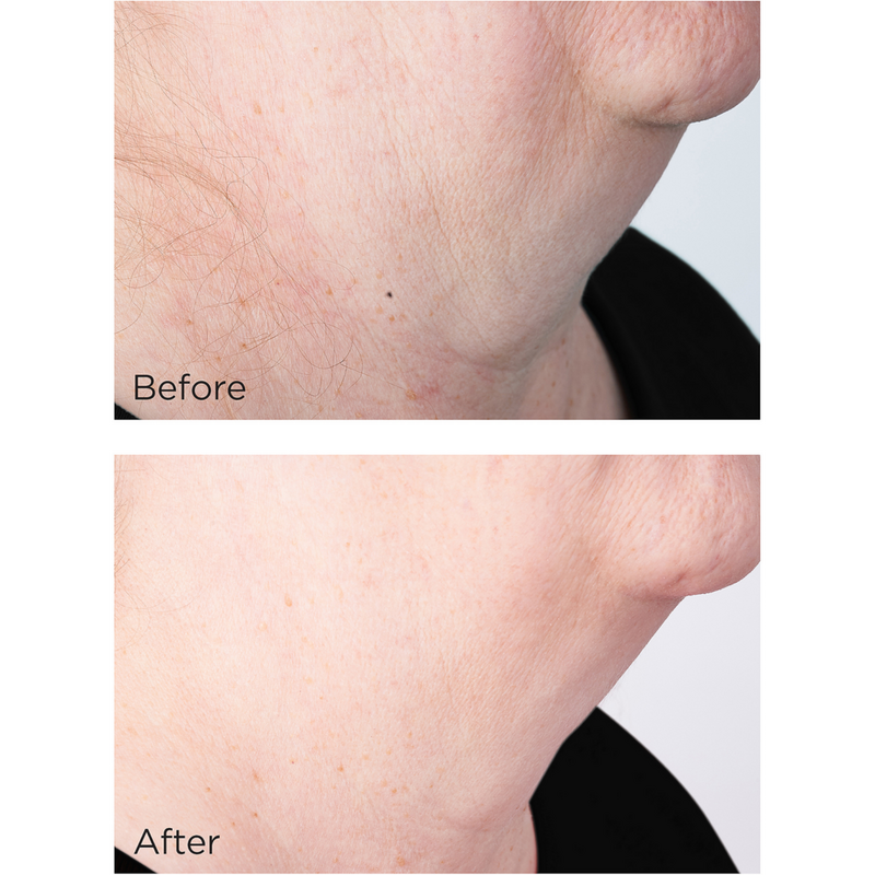 Perricone MD Cold Plasma Plus+ Sub-D/Neck #5