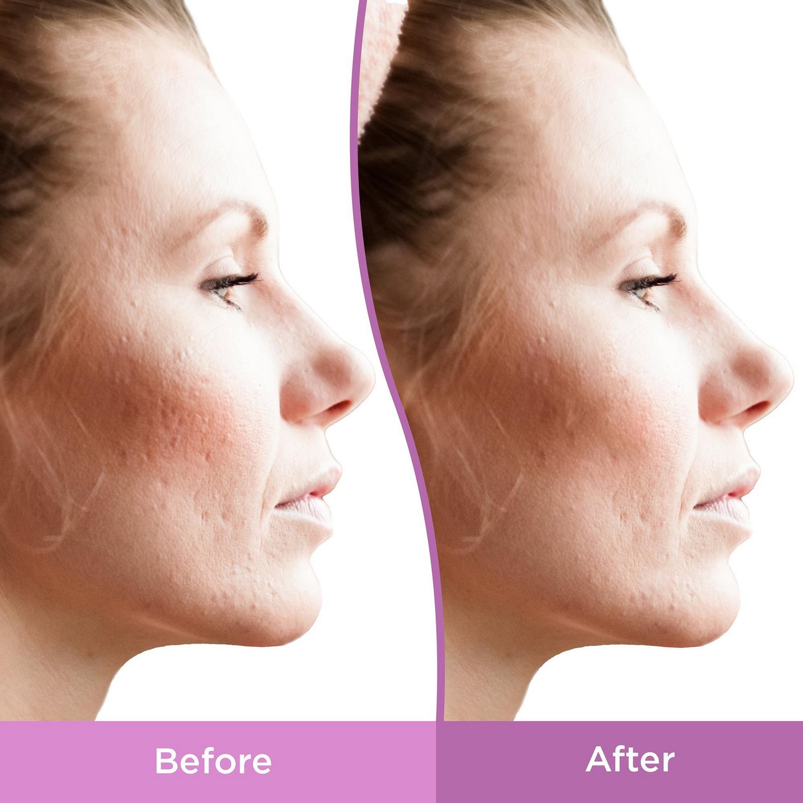 Resurfacing Acne Scar Spot Treatment Gel