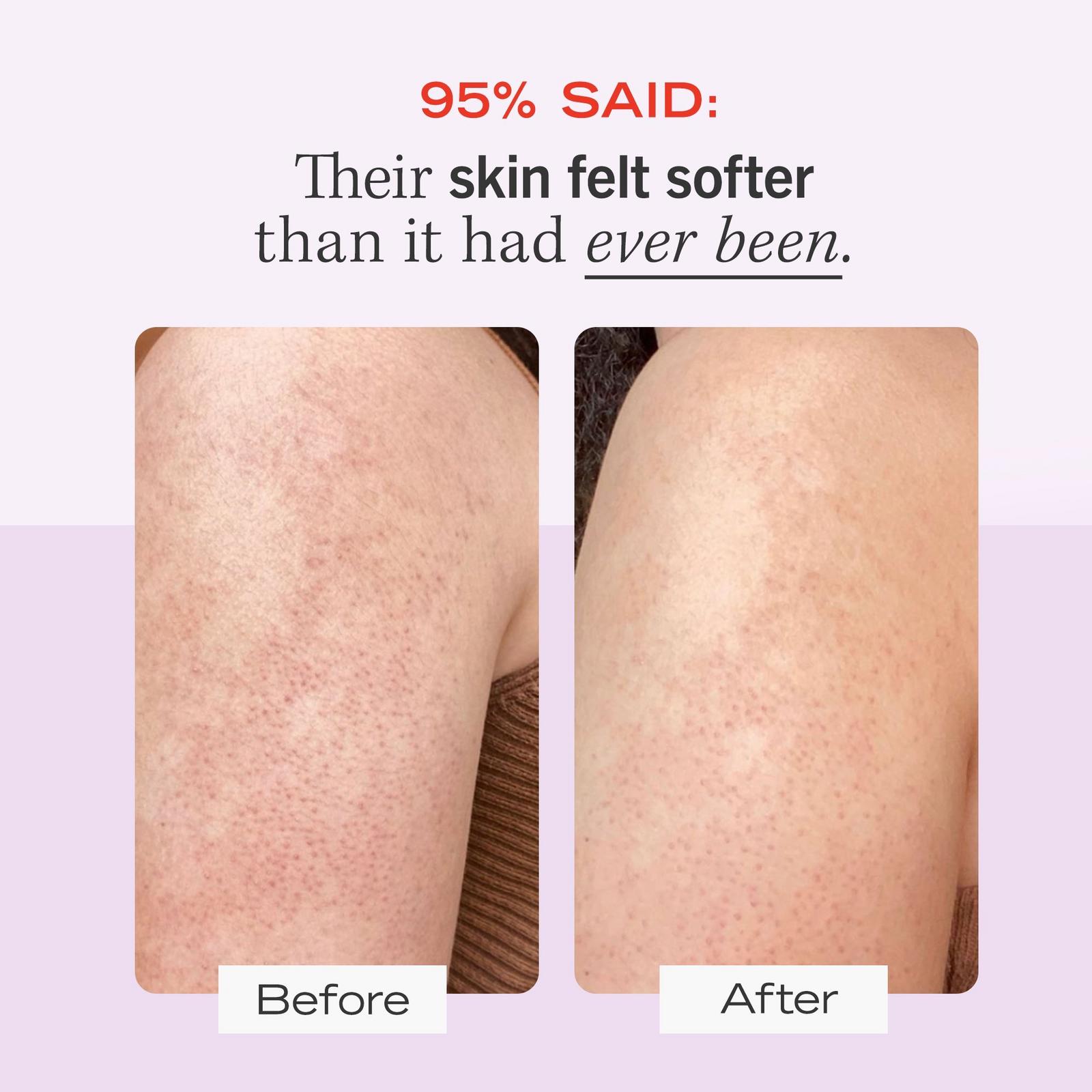 Travel Size KP Bump Eraser Body Scrub with 10% AHA