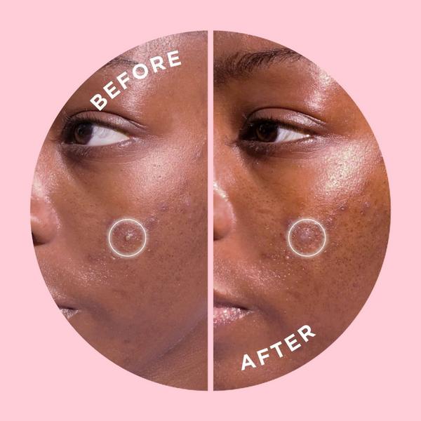 ZitSticka GOO GETTER Surface Zit Hydrocolloid Patch #6