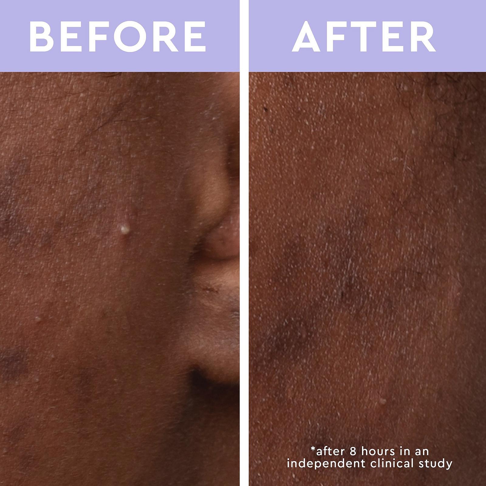Spot a Spot Acne Patches