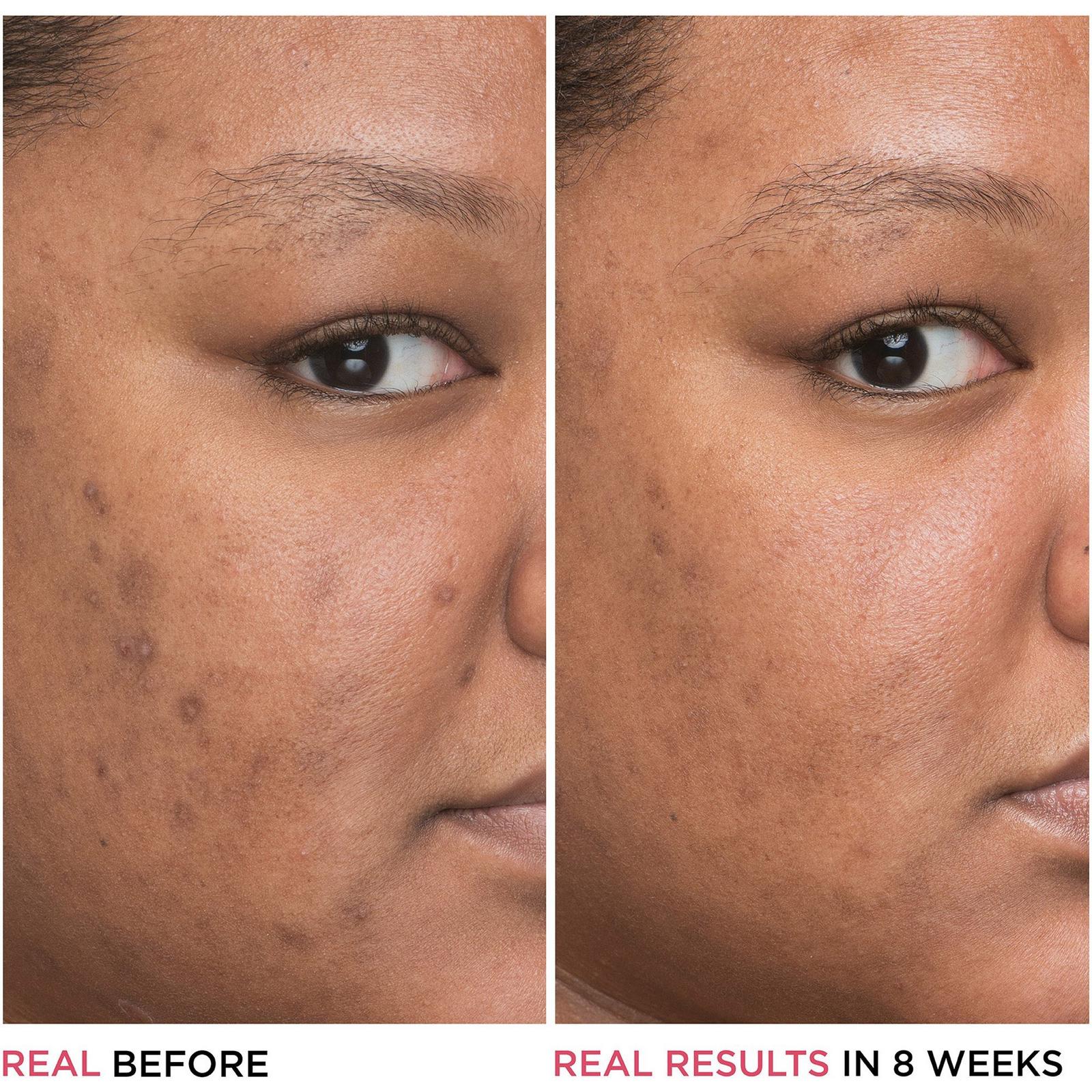 Bye Bye Dark Spots Niacinamide Serum