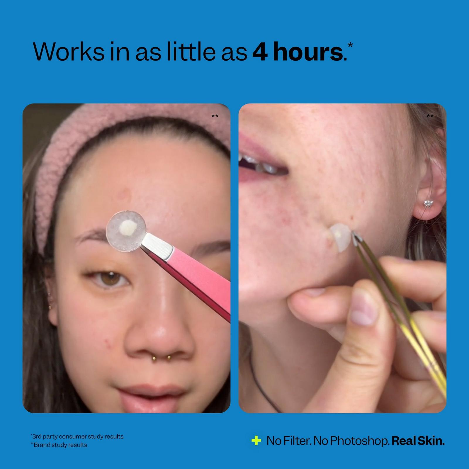 Acne Spot Dots