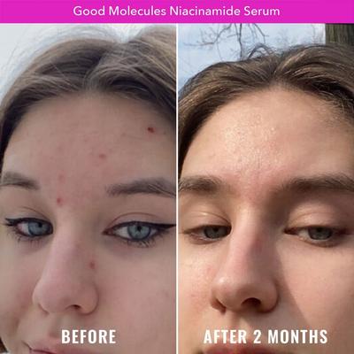 Niacinamide Serum