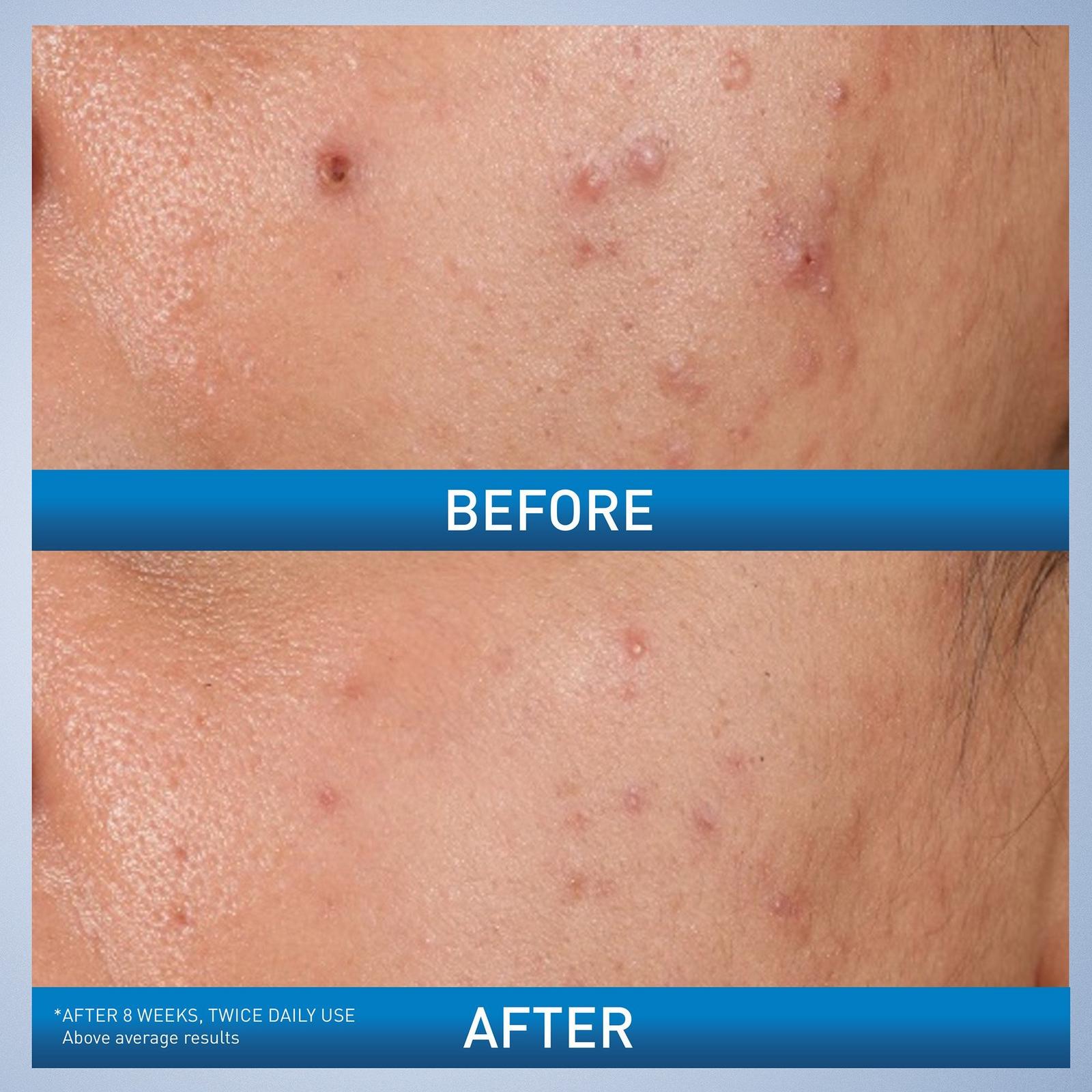 Acne Control Gel with AHA & BHA for Acne Prone Skin