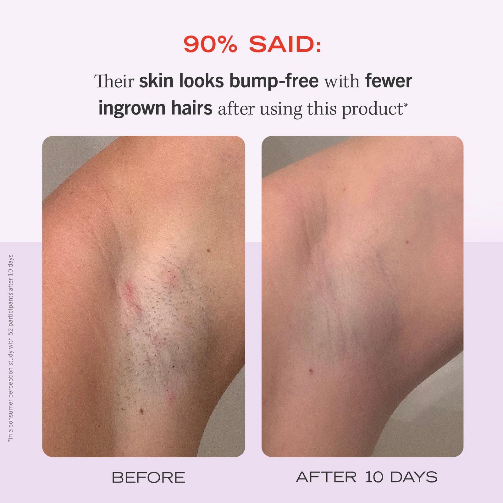 Ingrown Hair Pads with BHA & AHA