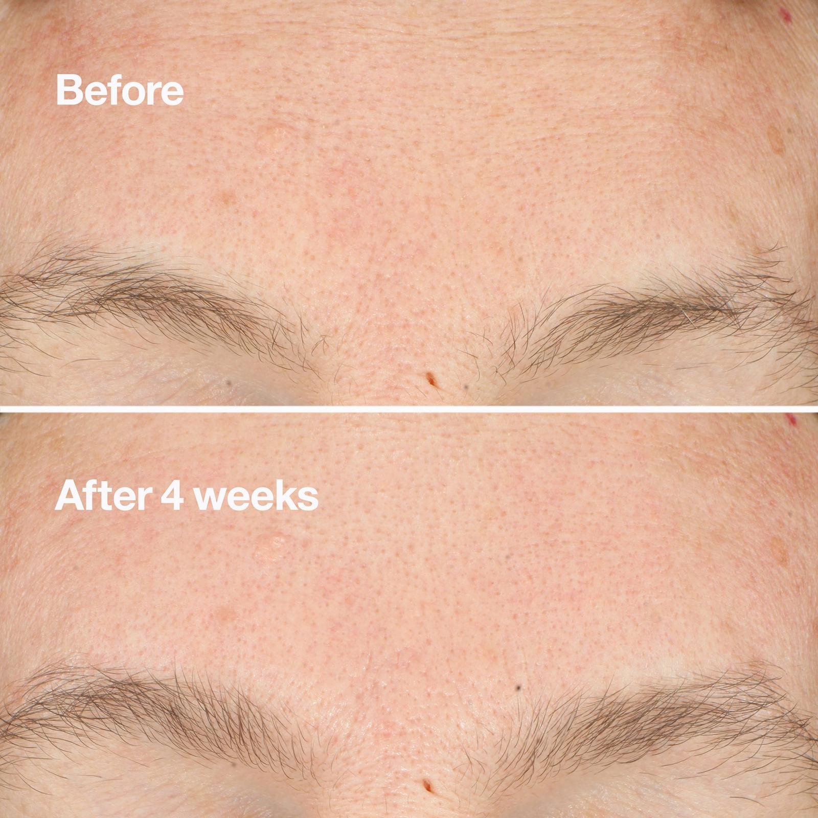 Clarifying Do-Over Peel