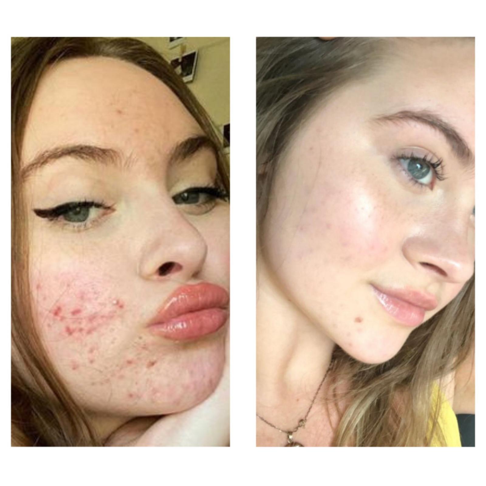Break-Out Spot Treatment for Large Bumps and Breakouts