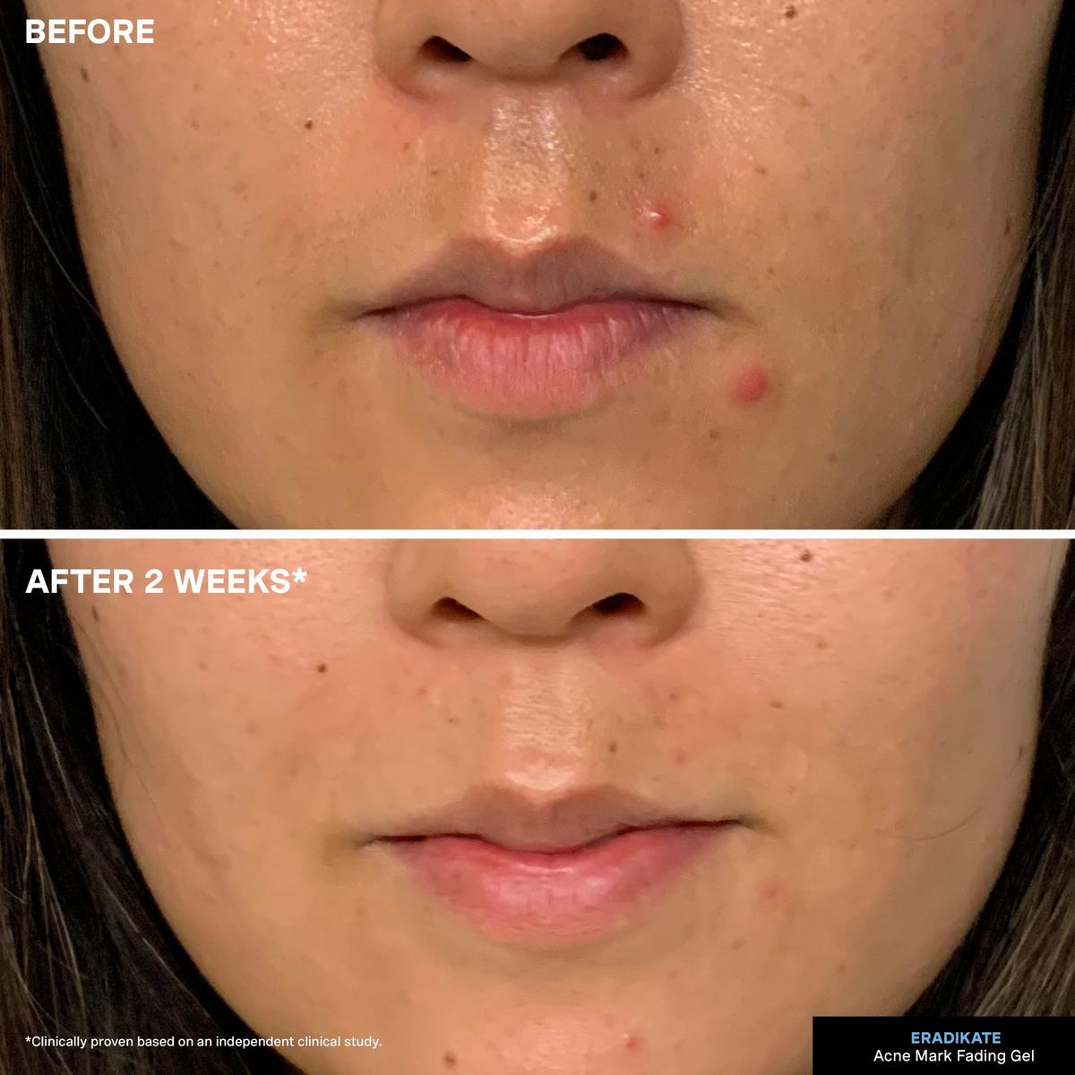 Kate Somerville EradiKate Acne Mark Fading Gel Ulta Beauty