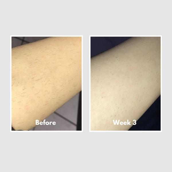HAPPYSKINCO Ice IPL Hair Removal Handset #6
