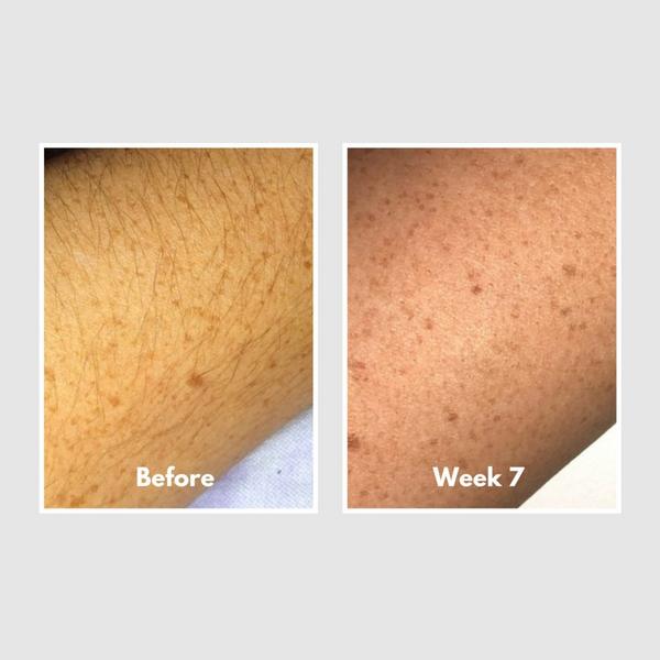 HAPPYSKINCO Ice IPL Hair Removal Handset #7