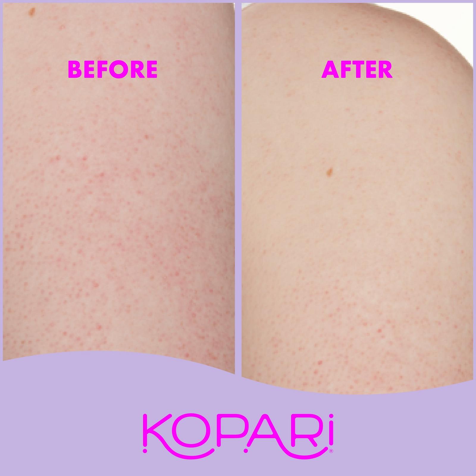 KP Body Bumps Be Gone With 10% AHA
