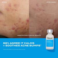 Deep Relief Acne Treatment with Soothing Phytosteroid