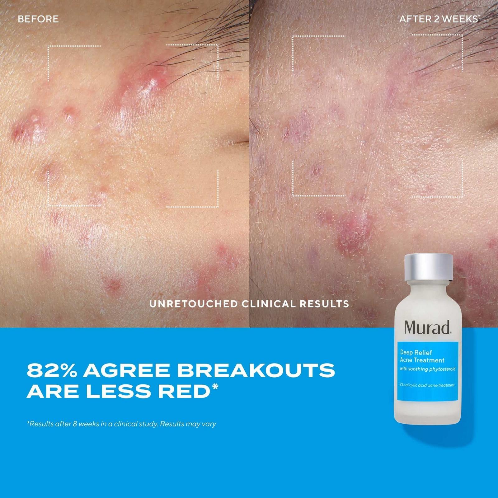 Deep Relief Acne Treatment with Soothing Phytosteroid
