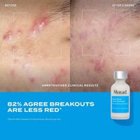 Deep Relief Acne Treatment with Soothing Phytosteroid