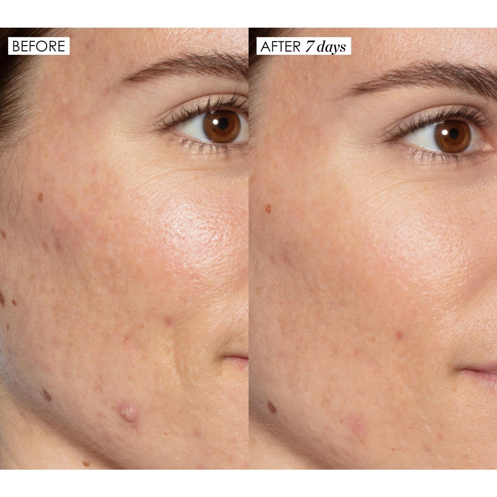 Mini Good Genes All-In-One Lactic Acid Treatment