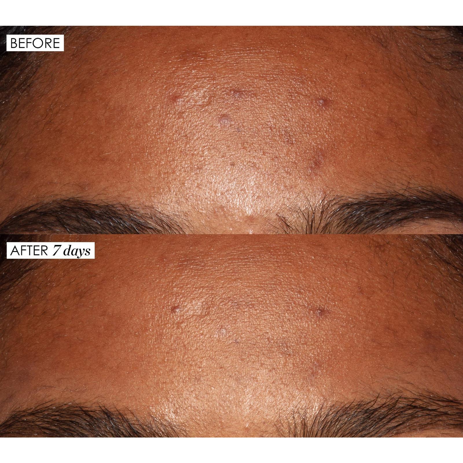 Mini Good Genes All-In-One Lactic Acid Treatment