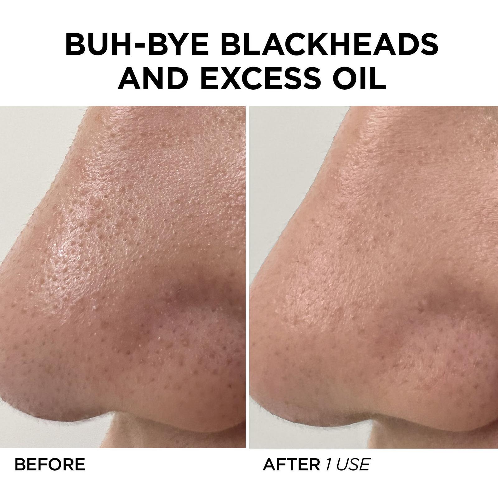 GLOfacial Hydro-Infusion Pore Cleansing + Blue LED Clarifying Tool