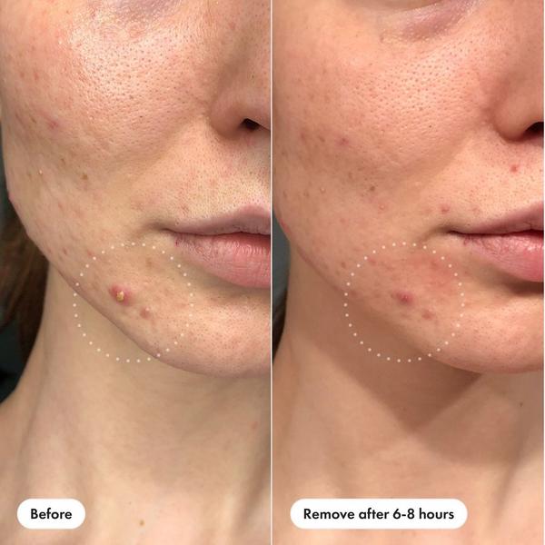 Hero Cosmetics Mighty Patch Invisible+ Daytime Hydrocolloid Acne Pimple Patches #2