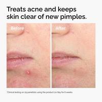 The Ordinary Salicylic Acid 2% Solution, Exfoliating Serum for Acne #3