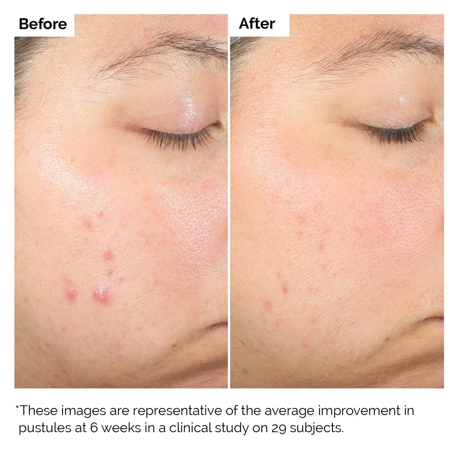 Salicylic Acid 2% Solution Serum