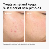 The Ordinary Salicylic Acid 2% Solution, Exfoliating Serum for Acne #4