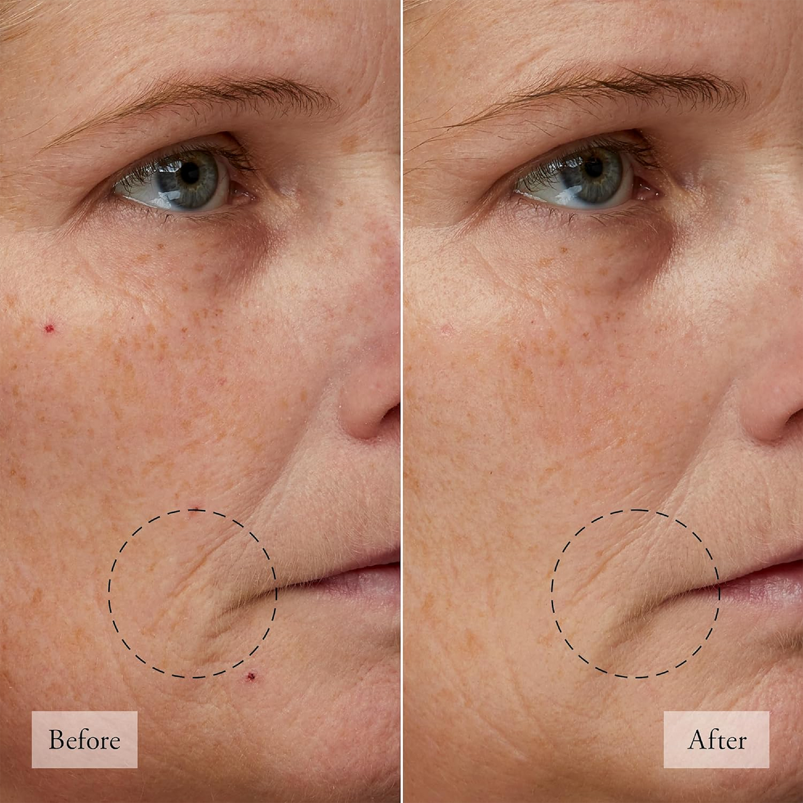 Microdelivery 2-Step Resurfacing Peel Kit